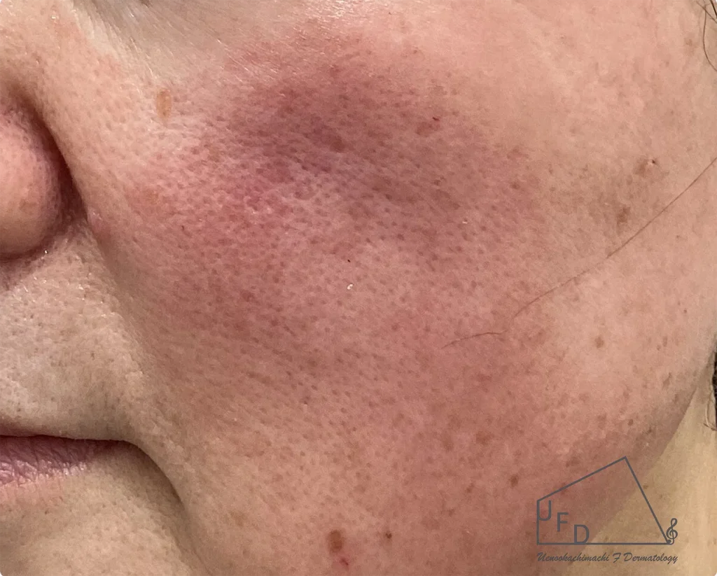 多くの方が悩まされる赤ら顔や顔のほてり　原因や症状 治療法について詳しく解説します