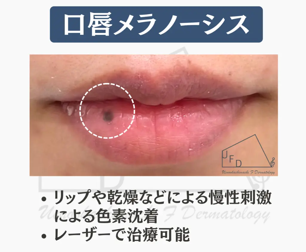 口唇メラノーシスとは