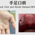 手足口病の症状