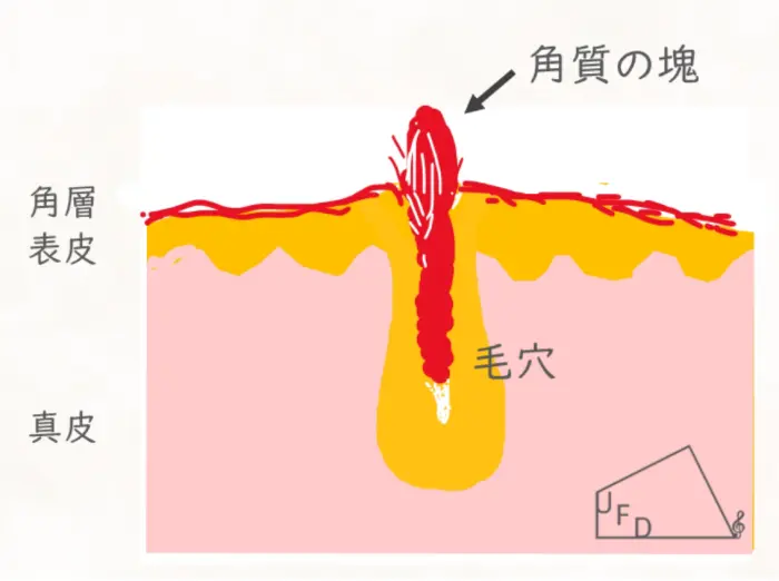 毛孔性苔癬の原因の図