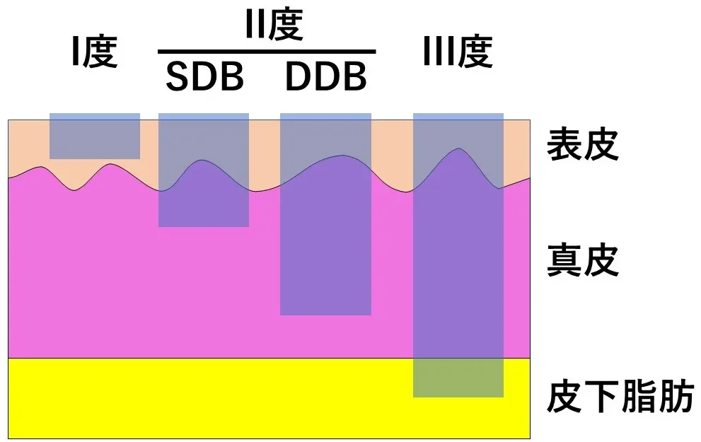 やけどの種類と深さ