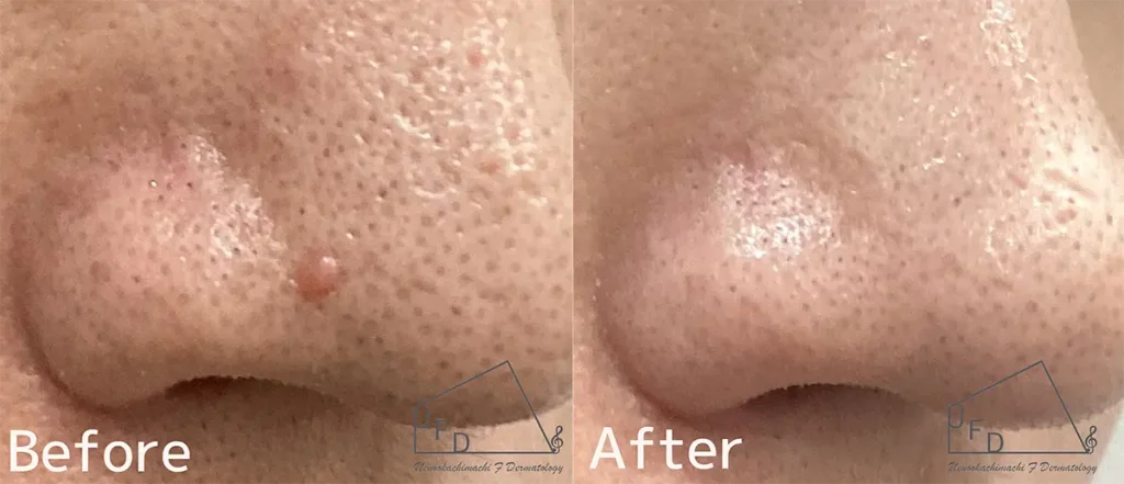 鼻の線維腫丘疹の症例1