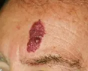 単純性血管腫の患部写真