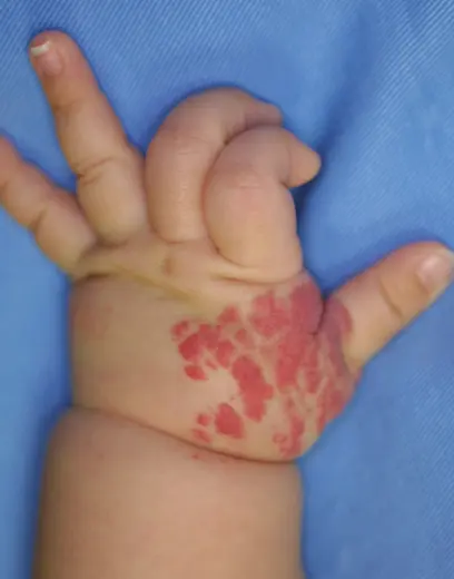 乳児血管腫 いちご状血管腫の患部写真