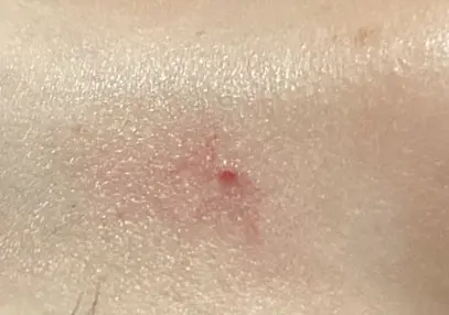 くも状血管腫の患部写真