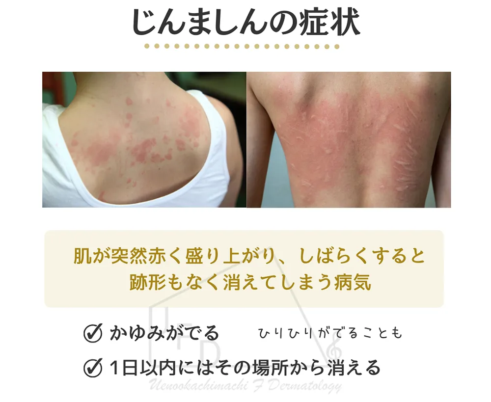 じんましんの症状