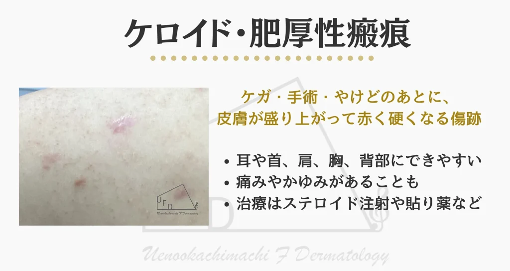 ケロイド(keloid)や肥厚性瘢痕(hypertrophic scar)について解説