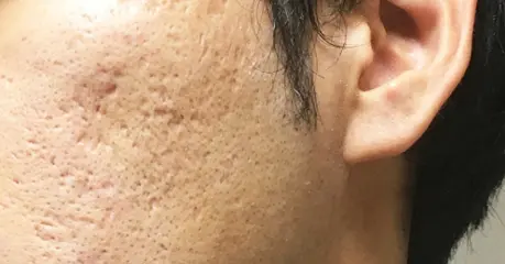 サブシジョン（深いニキビ跡の治療）