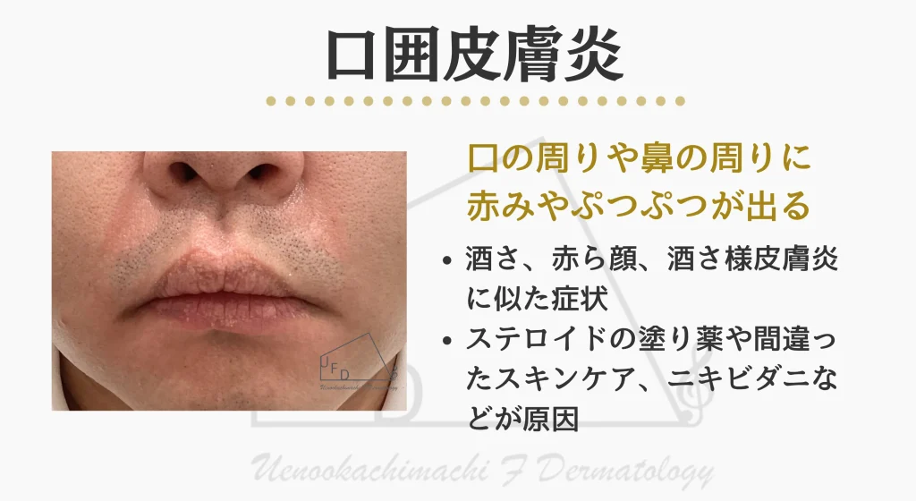 口囲皮膚炎の症状について解説