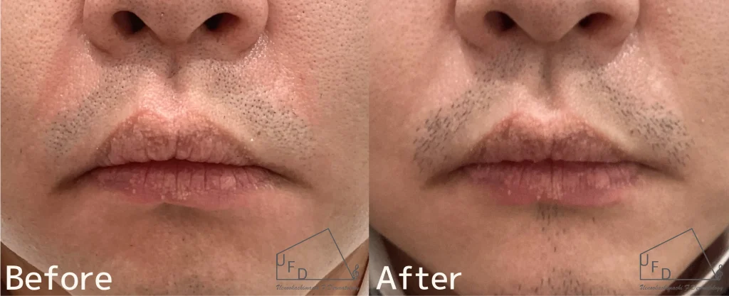 口囲皮膚炎の治療症例を紹介1