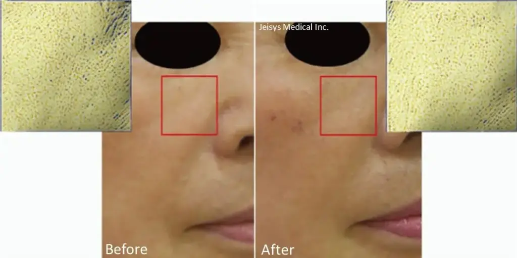 毛穴・小じわ。肌のハリ治療