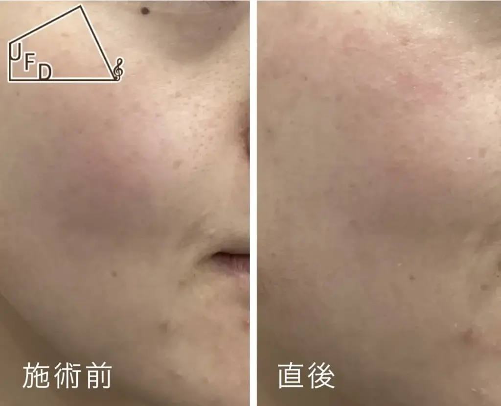 ニキビ跡治療3