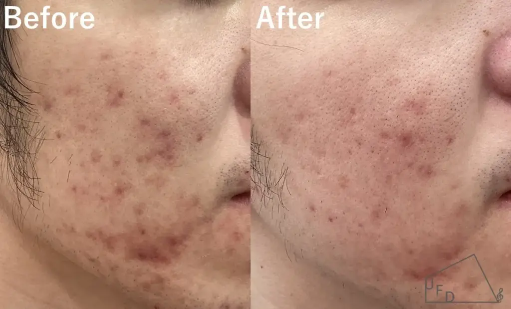 ポテンツァの症例2