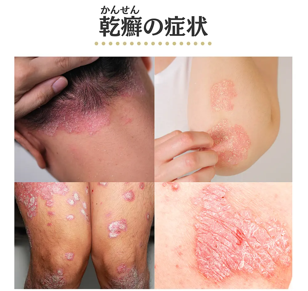 乾癬の症状