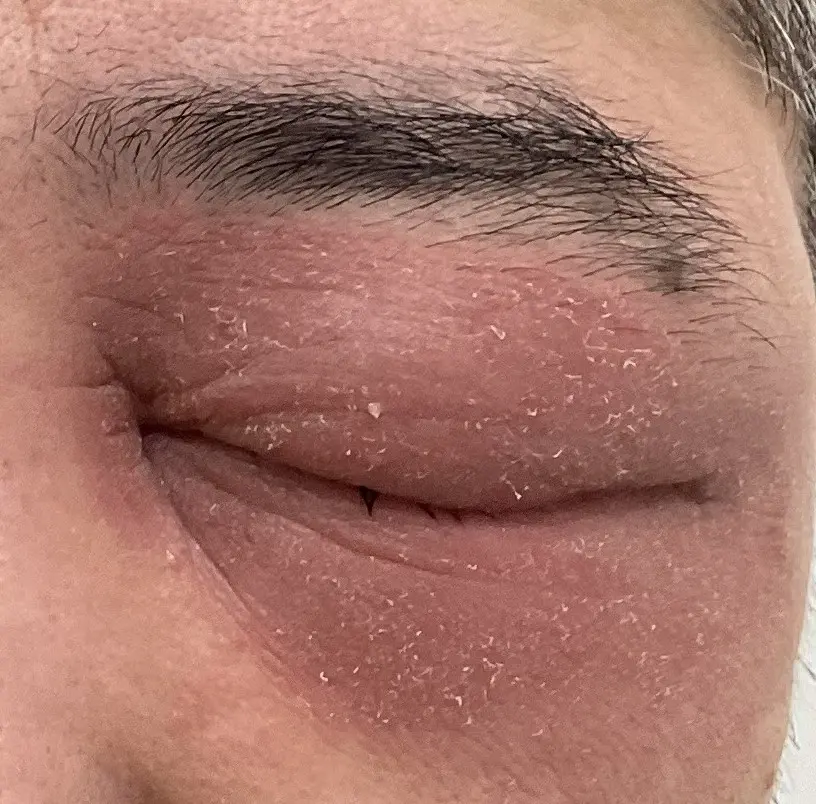 かぶれ（接触皮膚炎）