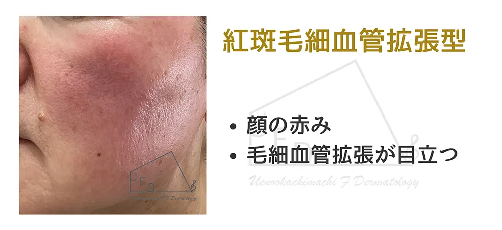 紅斑(こうはん)毛細血管拡張型(第I度 紅斑性酒さ)