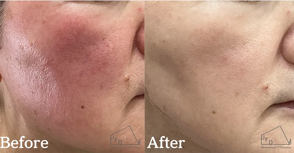 症例5 【60歳代女性】酒さ・赤ら顔