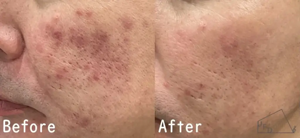 症例3 【50歳代男性】酒さ・赤ら顔