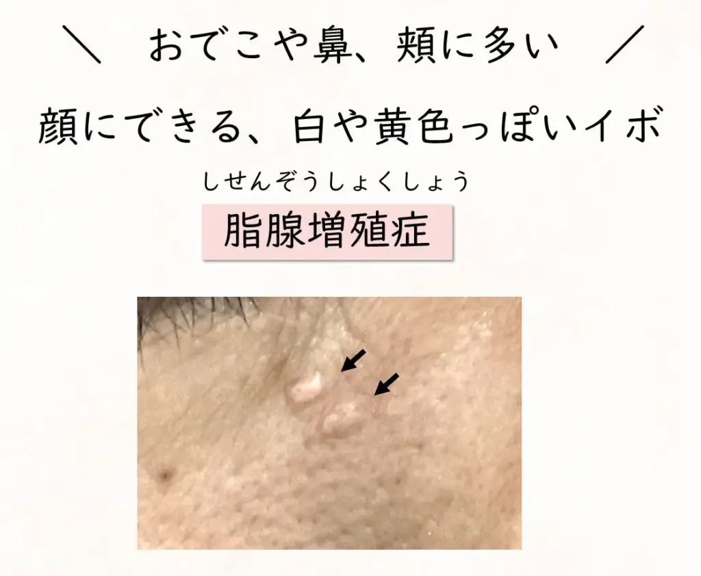 脂腺増殖症とは