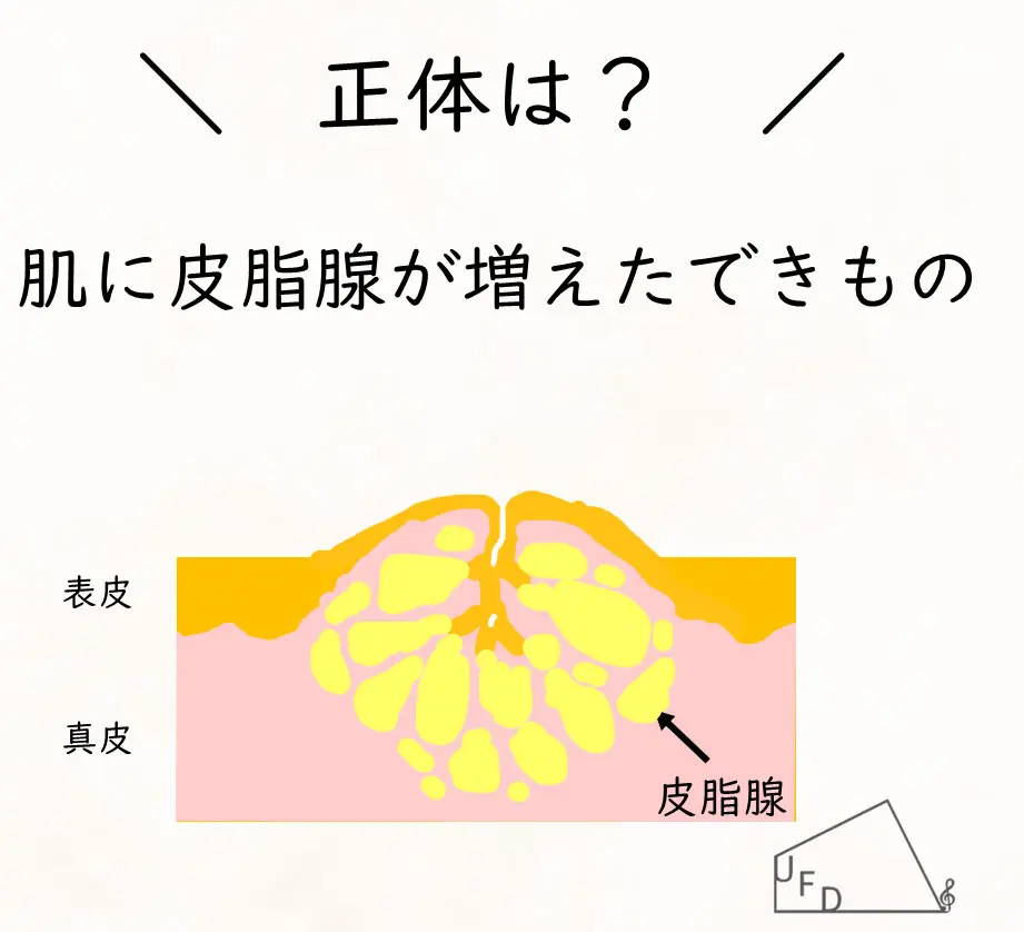 脂腺増殖症の特徴