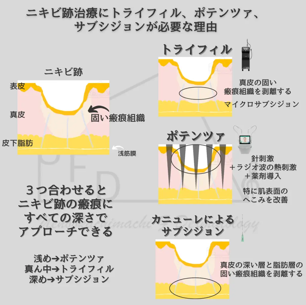 ニキビ跡への効果
