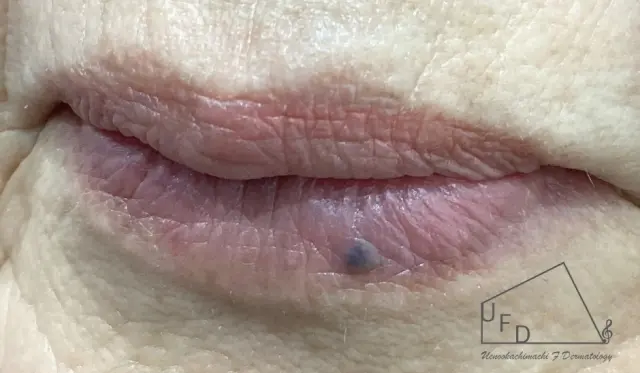 静脈湖(じょうみゃくこ、Venous Lake)とは