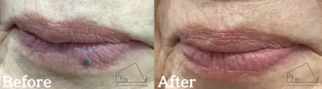 【60歳代女性】口唇の静脈湖ビフォーアフター