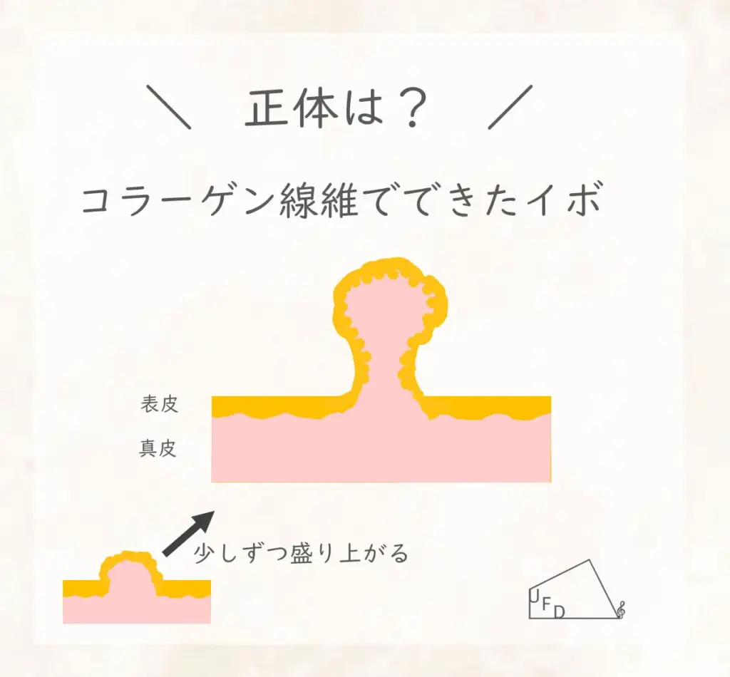 首イボの正体