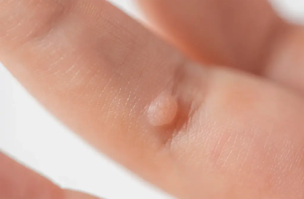 尋常性疣贅（じんじょうせいゆうぜい）
