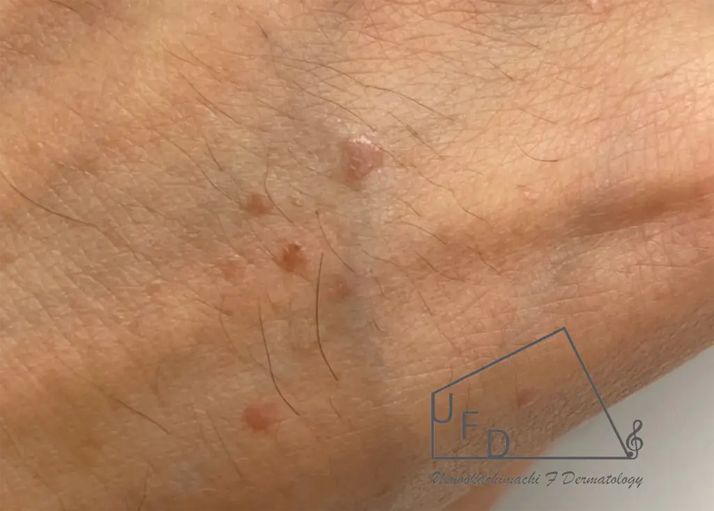 扁平疣贅（へんぺいゆうぜい）