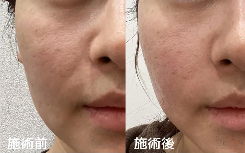 ボルニューマ症例2