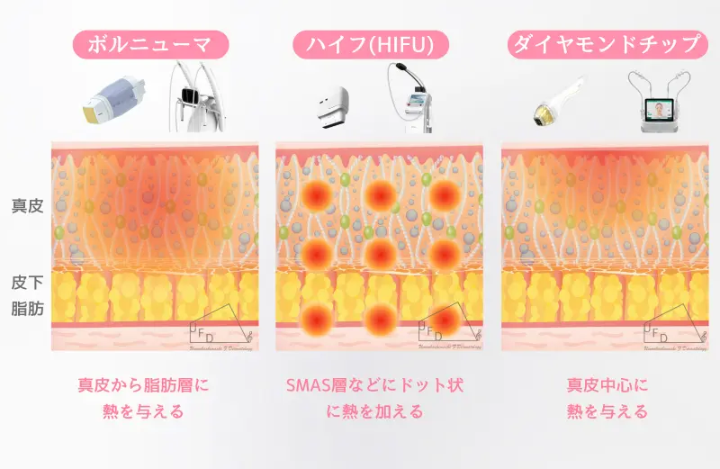 ボルニューマとハイフ(HIFU)やポテンツァダイヤモンドチップとの違い画像