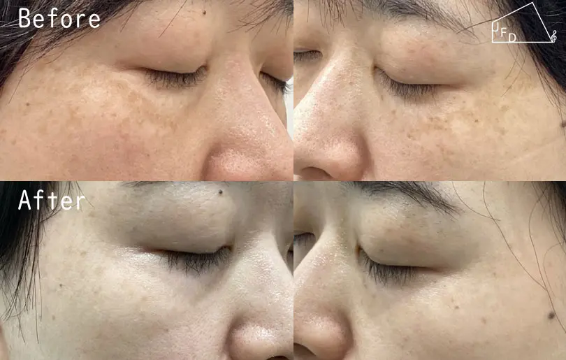 両頬の肝斑、老人性色素斑の症例