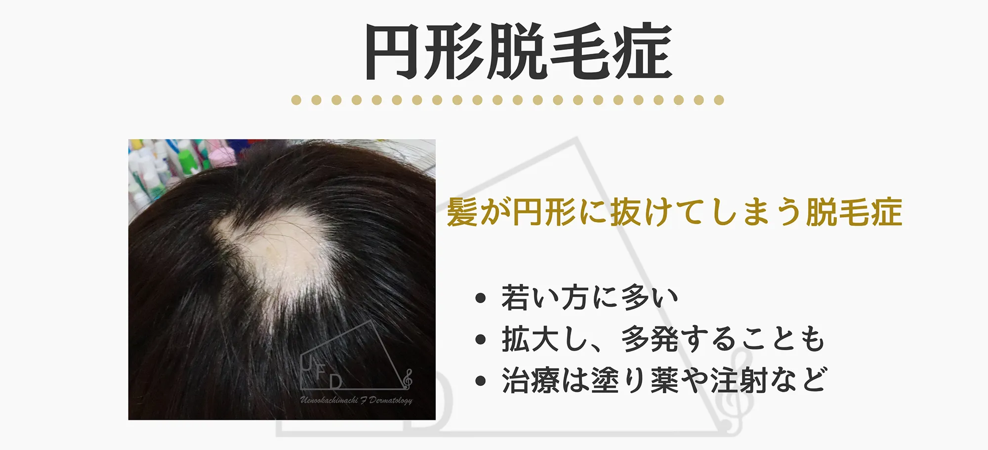 円形脱毛症の患部写真とともに症状 発症しやすい条件について説明