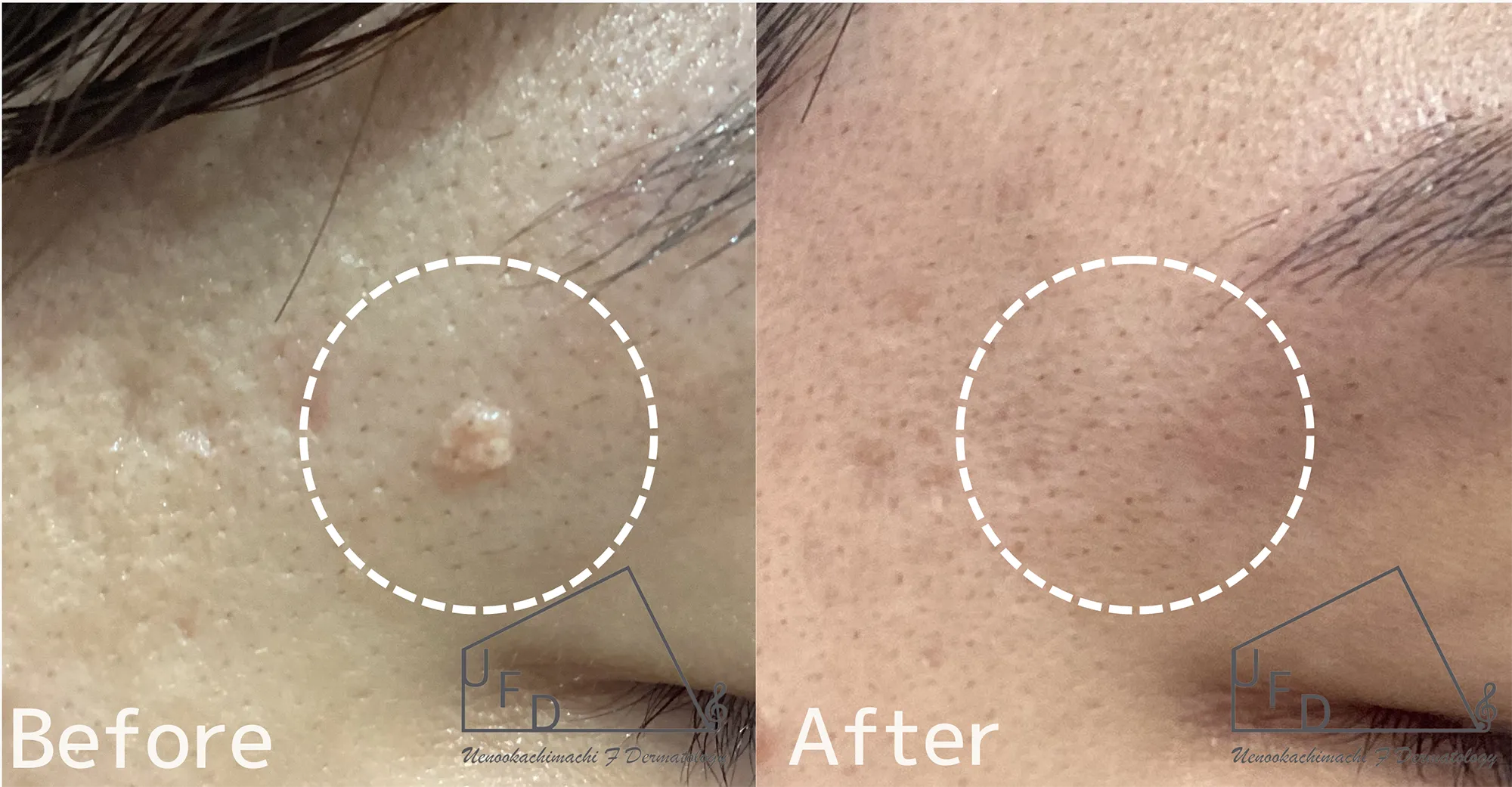 右こめかみの脂腺増殖症の症例写真