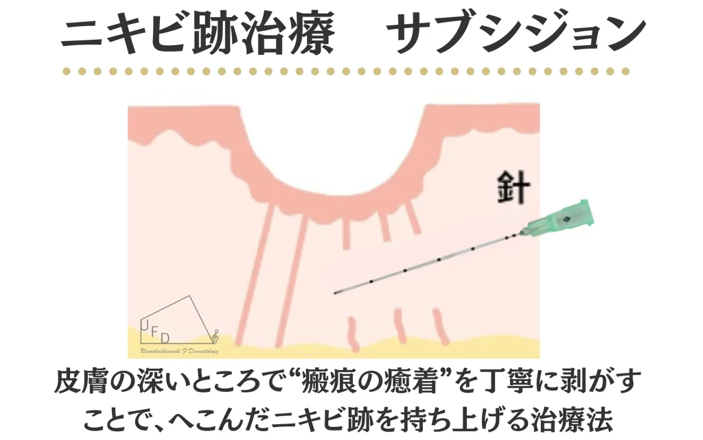 サブシジョンが効くニキビ跡・効きにくいニキビ跡の見分け方について画像付きで詳しく解説します