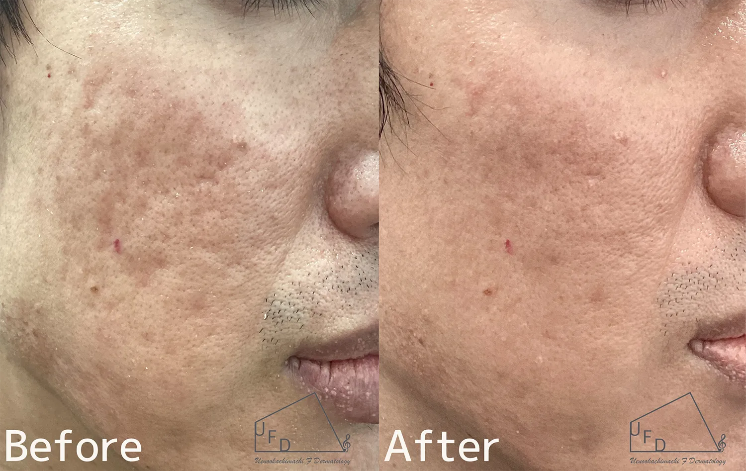 サブシジョンの施術症例について解説　症例１