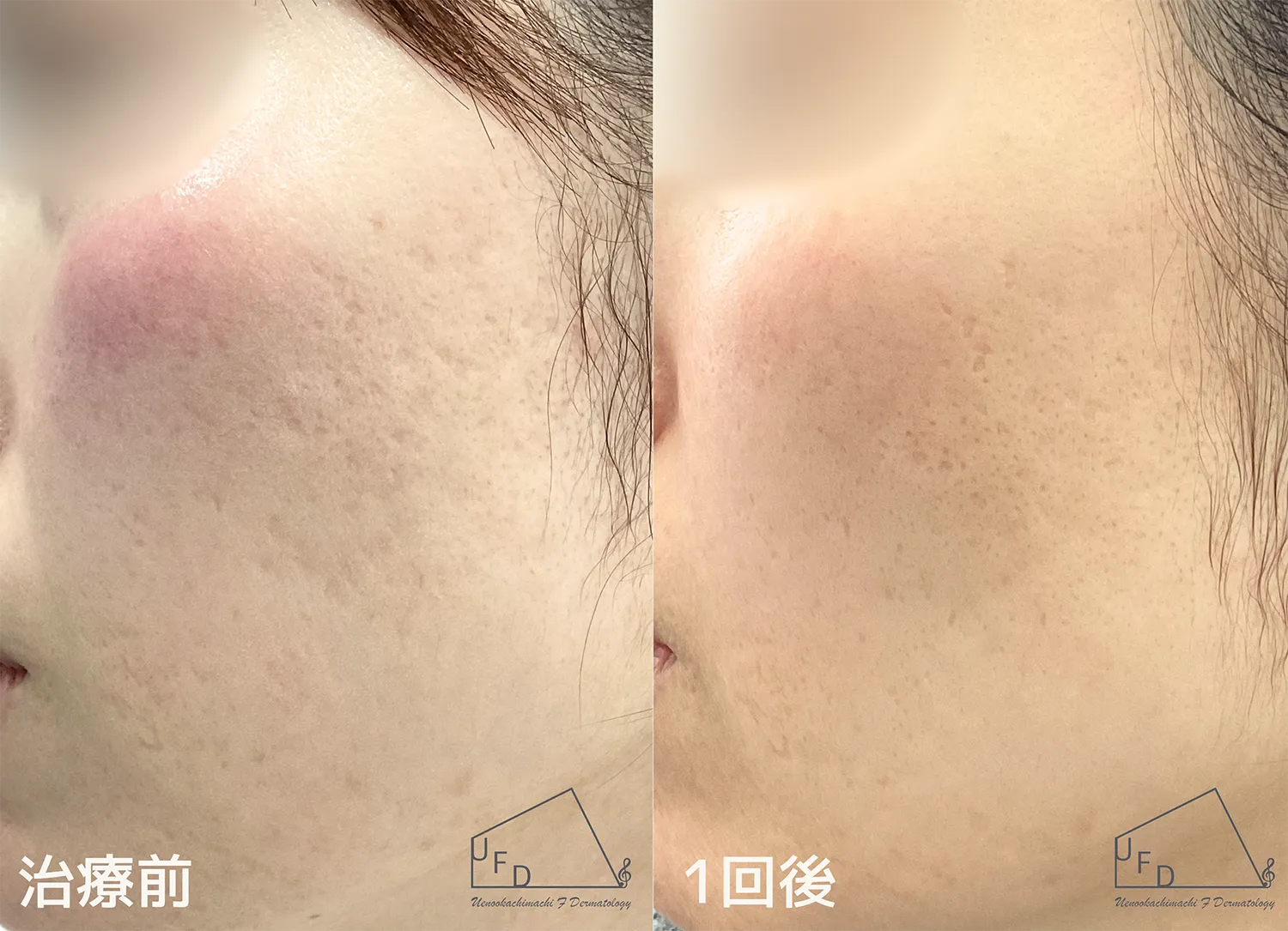 サブシジョンの施術症例について解説　症例２