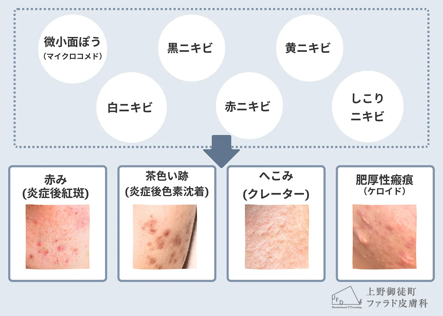 ニキビ跡の種類と症状を写真付きで解説