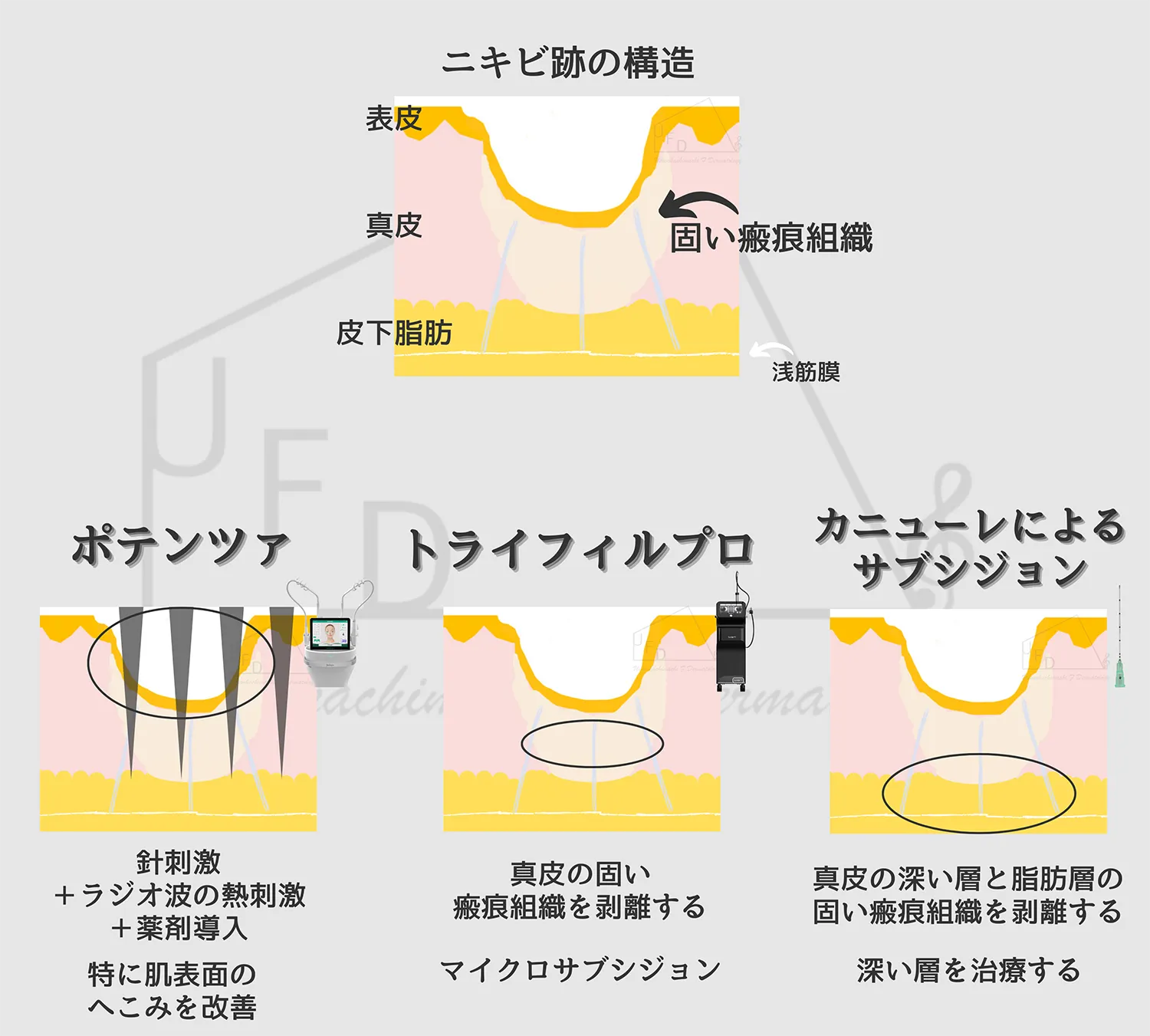 ニキビ跡に対するファラドメソッド