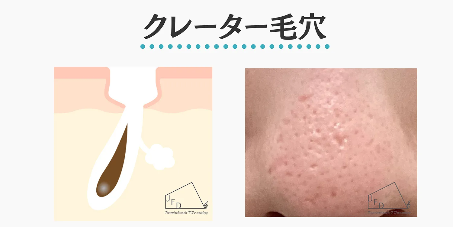 クレーター毛穴の特徴と治療法について解説