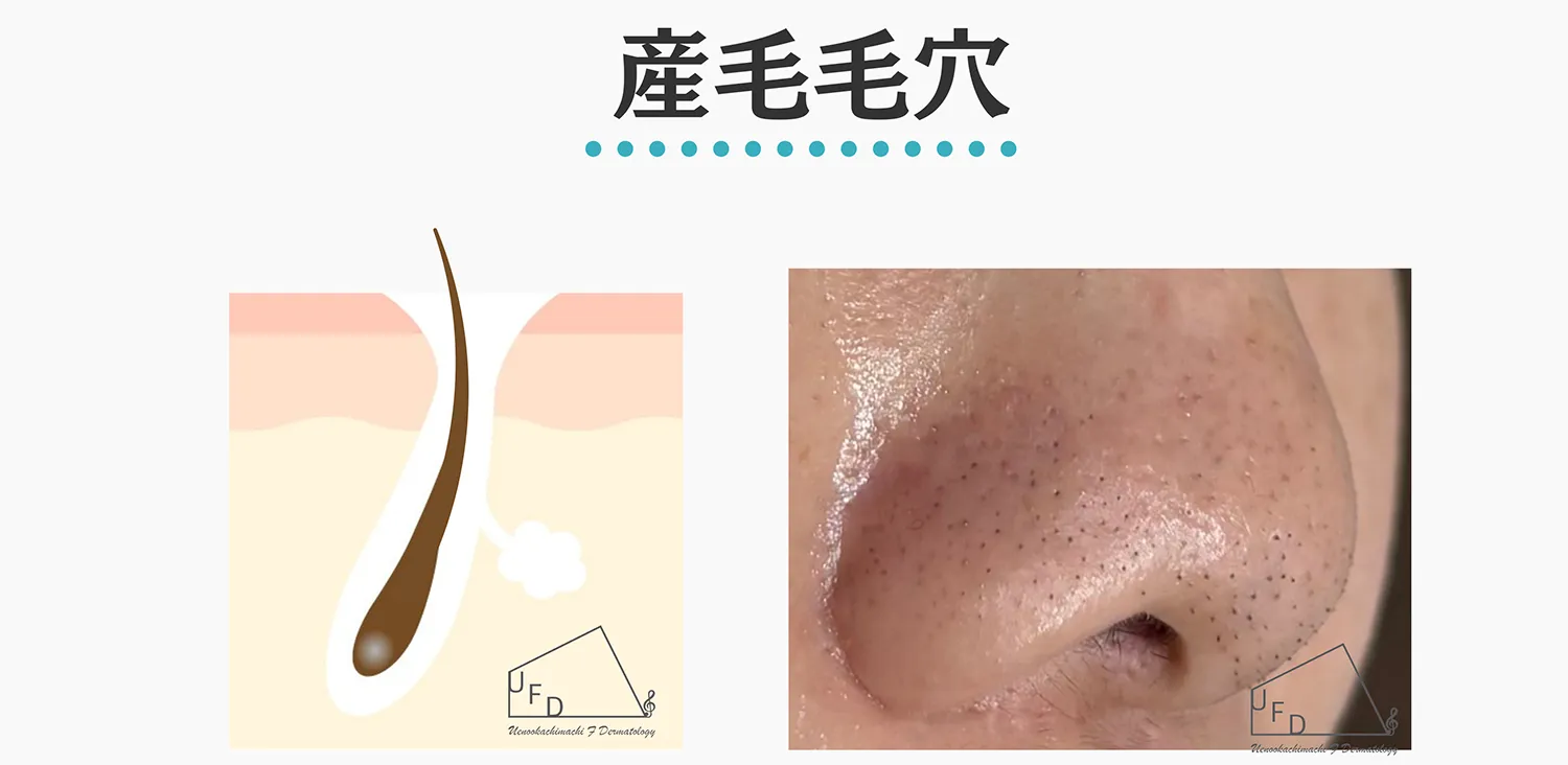 産毛毛穴の特徴と治療法について解説