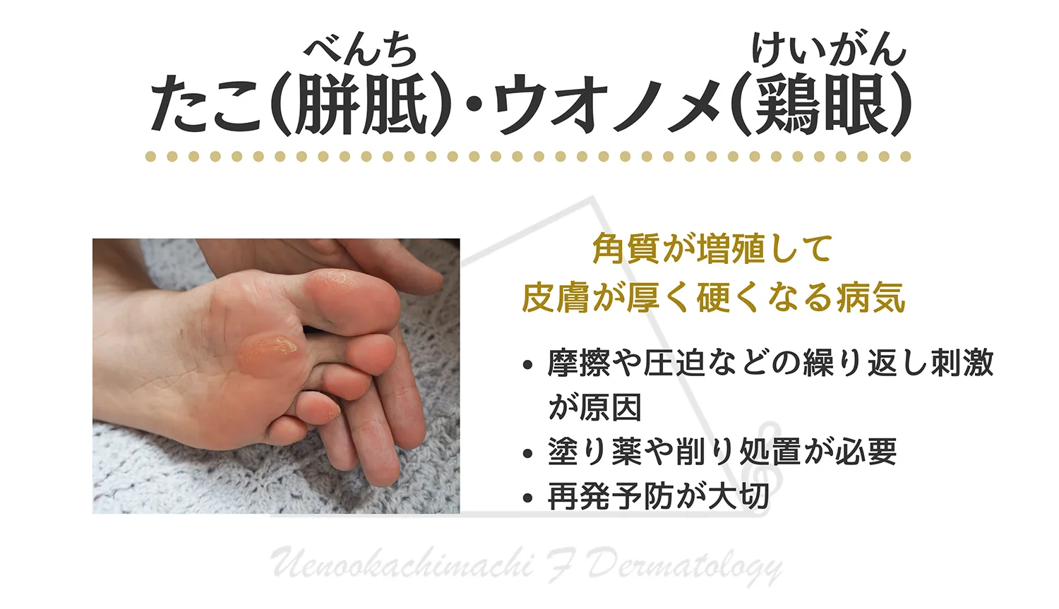 たこ うおのめについて画像付きで詳しく解説します