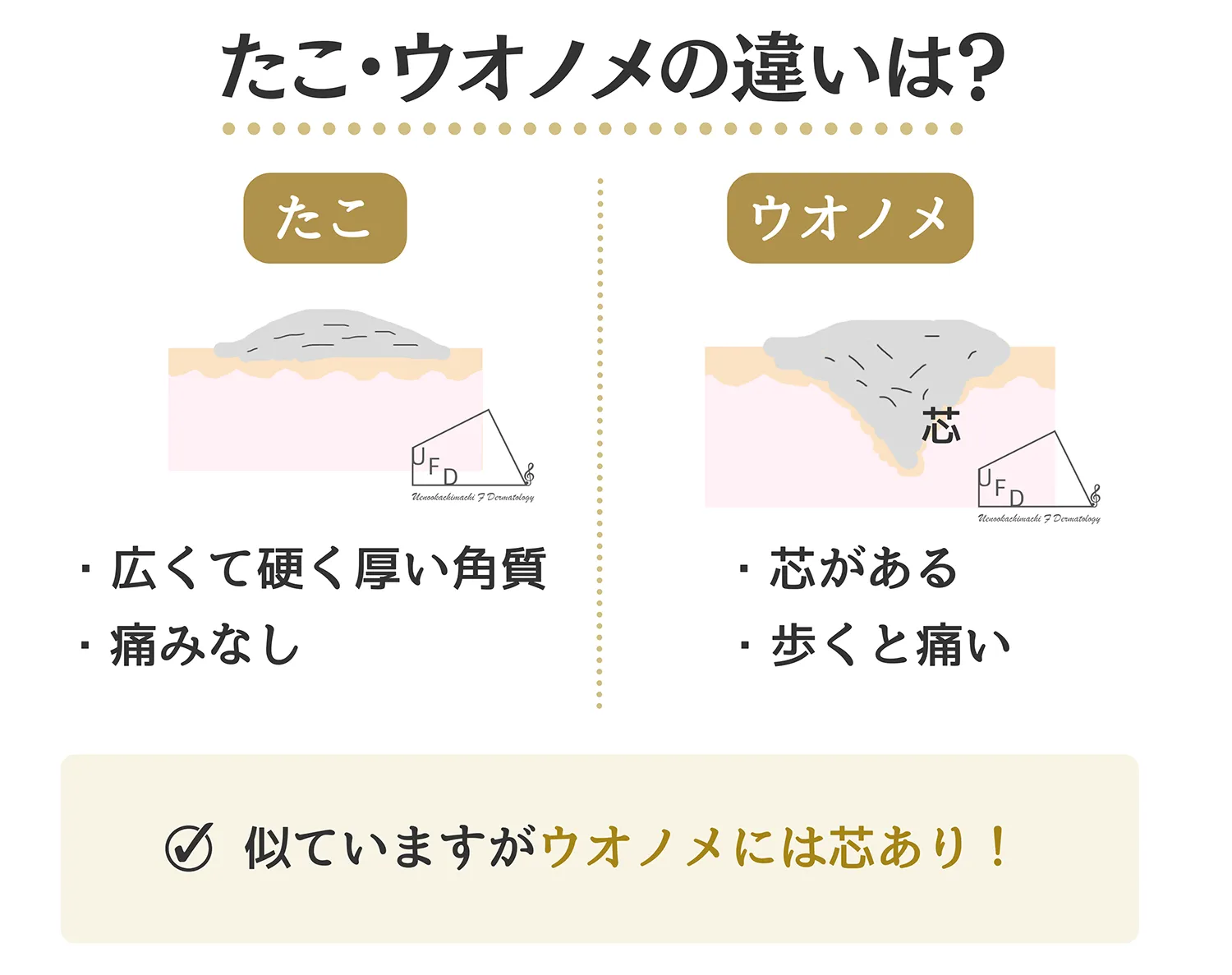たこ うおのめの患部を断面図にて解説します