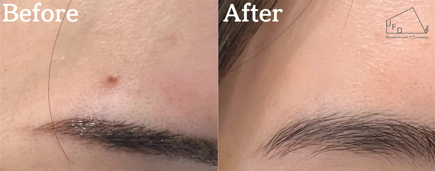 症例2【30歳代女性】右額のほくろ