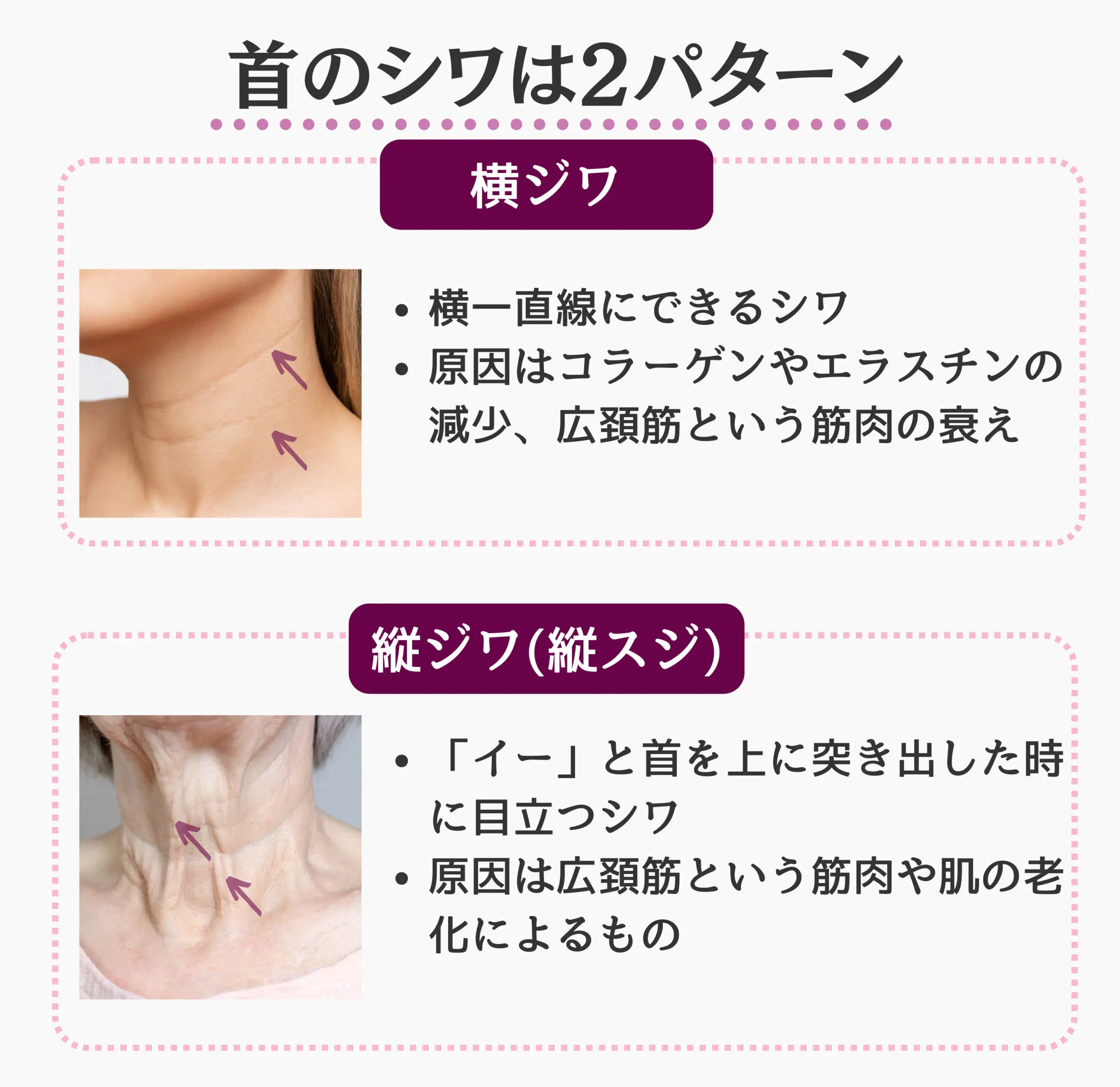 2種類の首のシワについて解説した画像