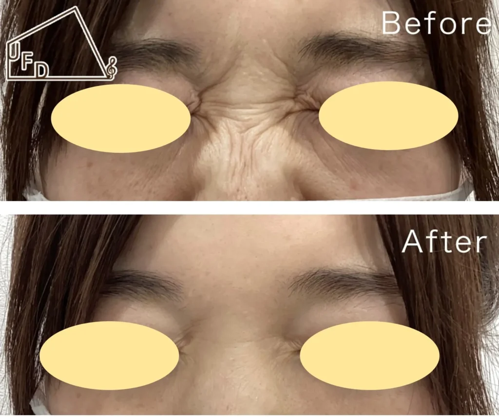 症例1 30歳代女性 眉間や鼻の表情ジワの改善 ボトックス注入実施