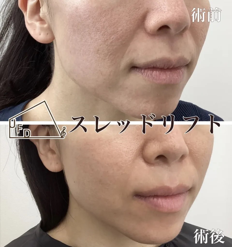 症例2 30歳代女性 ほうれい線の改善 糸リフトおよびヒアルロン酸注入実施