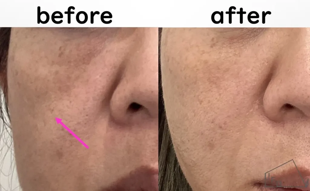 症例3 40歳代女性 ゴルゴ線とほうれい線の改善 糸リフト実施