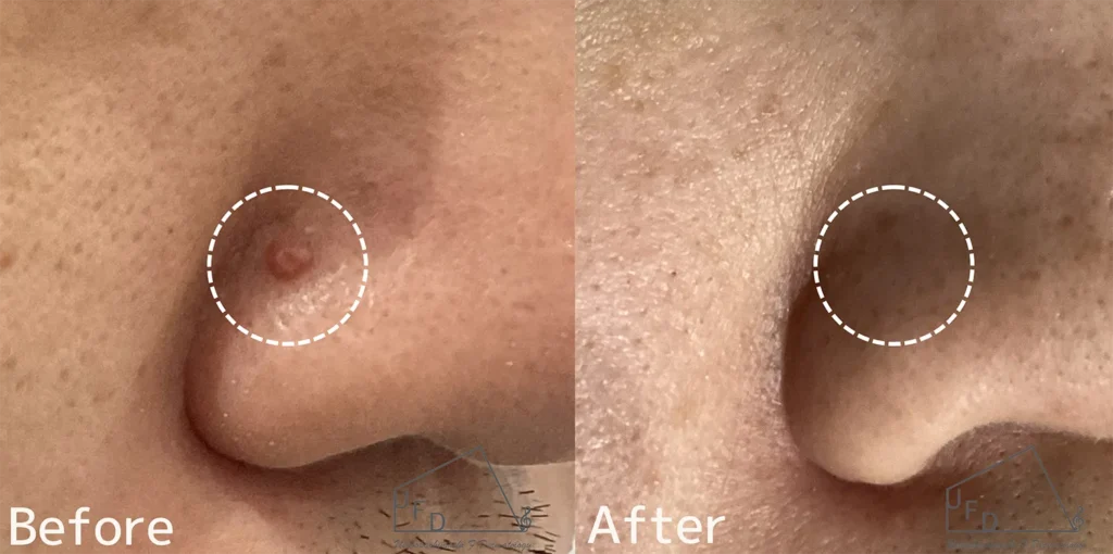 20歳代男性 鼻の線維腫丘疹 血管線維腫